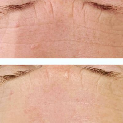 Microdermabrasion facial before and after Nataya Beauty Manchester skinbase microdermabrasion facial treatment before and after picture Nataya Beauty Manchester City centre