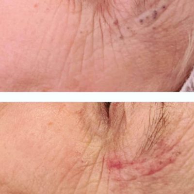 Microdermabrasion facial before and after Nataya Beauty Manchester skinbase microdermabrasion facial treatment before and after picture Nataya Beauty Manchester City centre